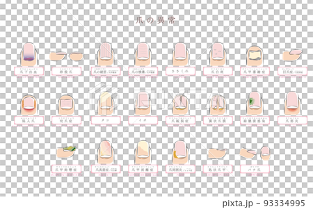 Illustration of nail abnormality / disease Illustration of nail abnormality / disease 93334995