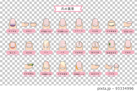 Illustration of nail abnormality / disease 93334996