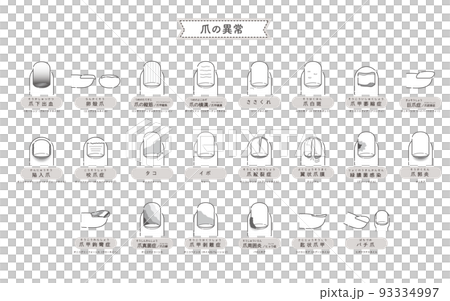 Illustration of nail abnormality / disease 93334997