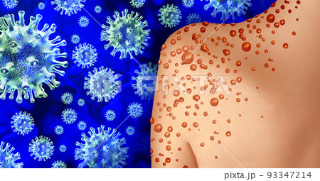 Monkey Pox Outbreak 93347214