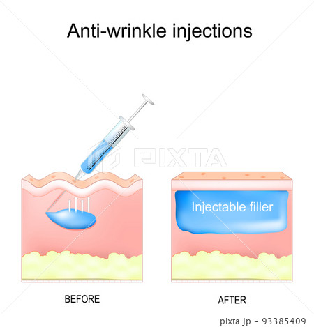 Anti-wrinkle injections. aesthetic procedure. 93385409