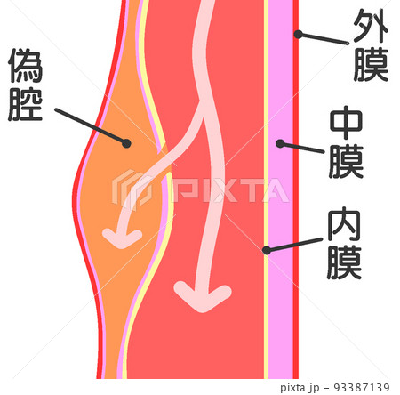 急性大動脈解離 93387139