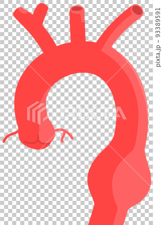 降主動脈瘤 93389591