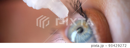 Drops from vial dripping into woman eye closeup Drops from vial dripping into woman eye closeup 93429272