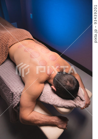 back of an athletic male client with traces, after massage with medical cups. relaxation in the spa salon on the massage table 93439201