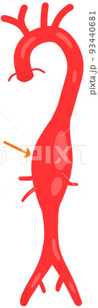 胸腹部大動脈瘤 93440681