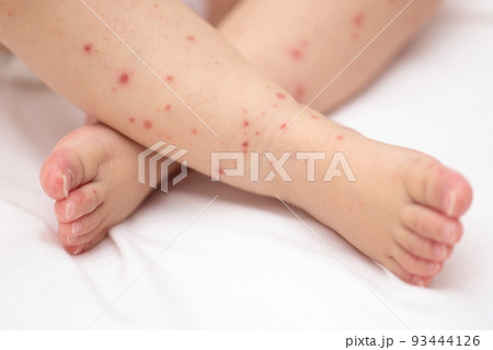 手足口病にかかった赤ちゃんの足 93444126