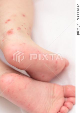 手足口病にかかった赤ちゃんの足 93444832