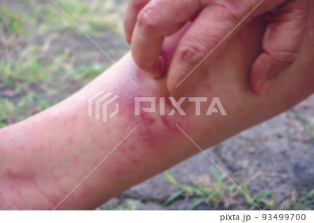 Blurred images while scratching hands-on dermatitis, viral dermatitis, itchy dermatitis, hives, dermatitis in the body, skin problems, allergic skin redness, and peeling of the skin on the legs. 93499700