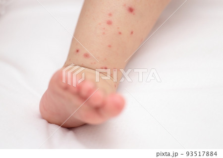 手足口病にかかった赤ちゃんの足 93517884