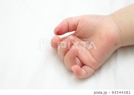 手足口病にかかった赤ちゃんの手 93544381