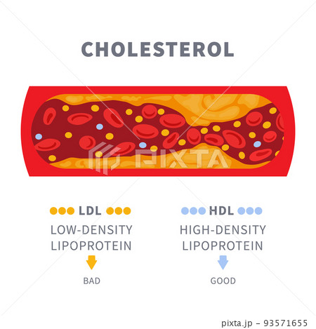 Cholesterol plaque buildup in blocked artery diagram Cholesterol plaque buildup in blocked artery diagram 93571655