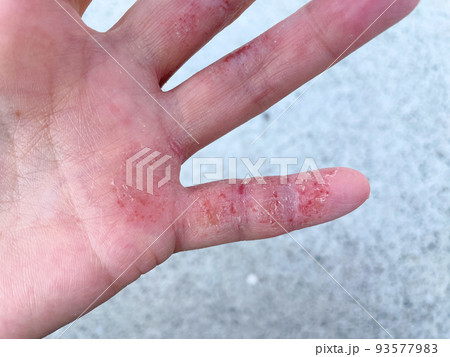 アトピー性皮膚炎患者の汗疱状湿疹、異汗性湿疹、皮膚炎、炎症手湿疹、代謝不良、アレルギー性皮膚炎 アトピー性皮膚炎患者の汗疱状湿疹、異汗性湿疹、皮膚炎、炎症手湿疹、代謝不良、アレルギー性皮膚炎 93577983