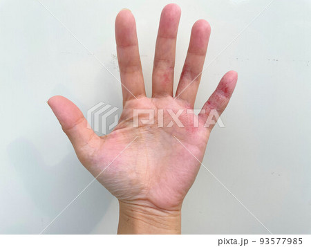 アトピー性皮膚炎患者の汗疱状湿疹、異汗性湿疹、皮膚炎、炎症手湿疹、代謝不良、アレルギー性皮膚炎 アトピー性皮膚炎患者の汗疱状湿疹、異汗性湿疹、皮膚炎、炎症手湿疹、代謝不良、アレルギー性皮膚炎 93577985