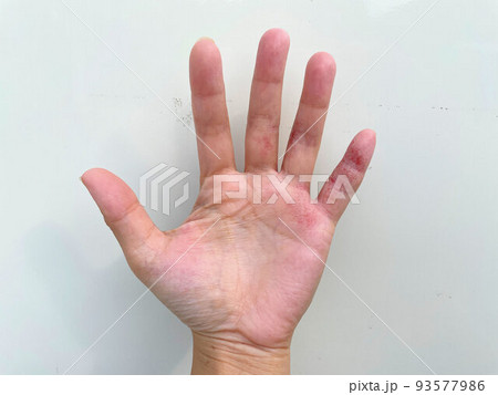 アトピー性皮膚炎患者の汗疱状湿疹、異汗性湿疹、皮膚炎、炎症手湿疹、代謝不良、アレルギー性皮膚炎 アトピー性皮膚炎患者の汗疱状湿疹、異汗性湿疹、皮膚炎、炎症手湿疹、代謝不良、アレルギー性皮膚炎 93577986