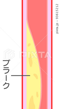閉塞性動脈硬化症 93615212