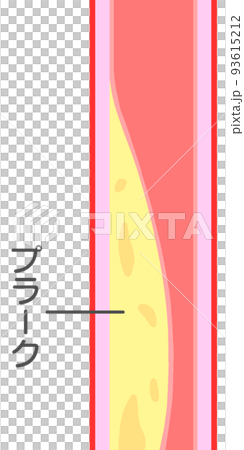 閉塞性動脈硬化症 93615212