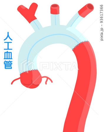胸部大動脈人工血管置換術 93617366