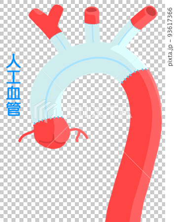 胸部大動脈人工血管置換術 93617366