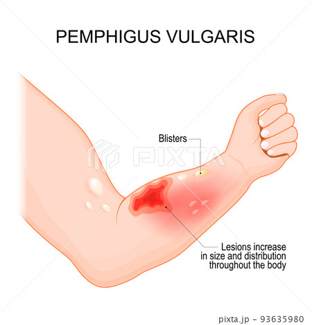 Pemphigus vulgaris. Arm with Blisters Pemphigus vulgaris. Arm with Blisters 93635980