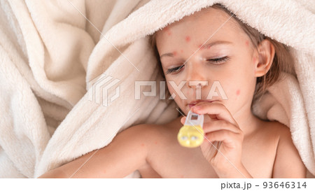 Child with chicken pox lying in bed with Thermometer Child with chicken pox lying in bed with Thermometer 93646314