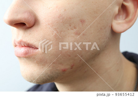 Concept of skin care with problem skin, close up Concept of skin care with problem skin, close up 93655412