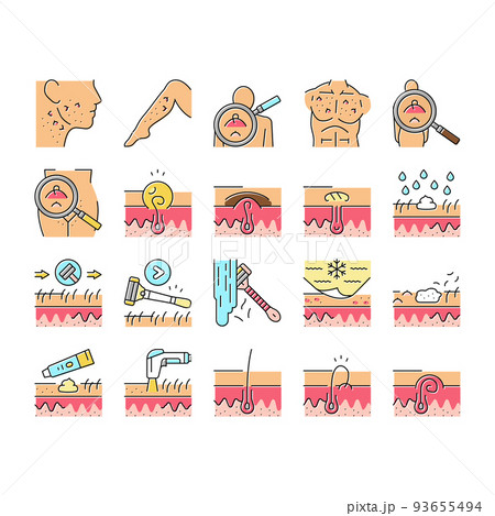 Ingrown Hair Problem Treatment Icons Set Vector Ingrown Hair Problem Treatment Icons Set Vector 93655494