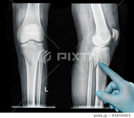 Xray images showing real fracture of leg bone under the knee medical glove point out 93656905