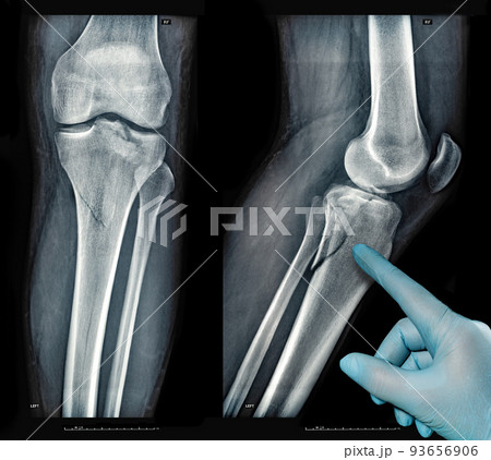 Xray images showing real fracture of leg bone under the knee after injury Xray images showing real fracture of leg bone under the knee after injury 93656906