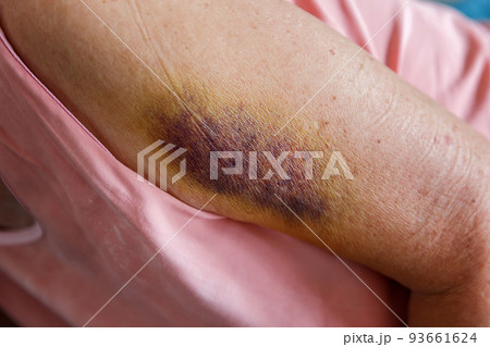 Large dark bruises or hematoma on arm of an elderly person. Painful accident. Large dark bruises or hematoma on arm of an elderly person. Painful accident. 93661624