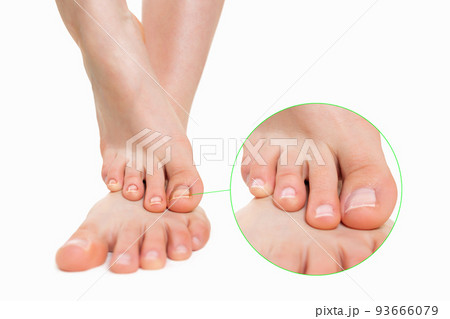 Female feet placed one on top of the other, with nail fungus disease. Zoomed image of the nail, the result after treatment. Isolated. Concept of dermatological diseases and fungi of the foot and nail 93666079
