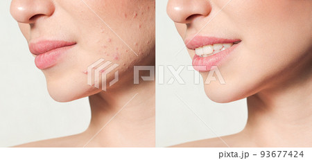 Teenage girl before and after acne treatment Skin care concept. Acne treatment in a cosmetology clinic. 93677424