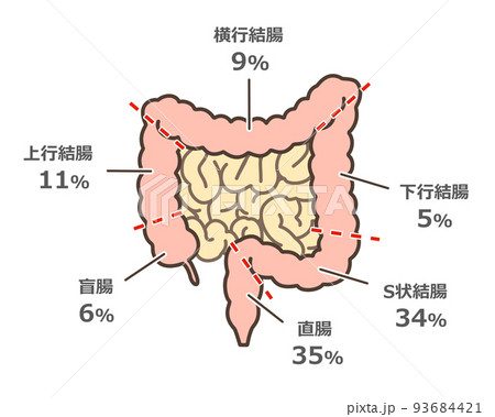 大腸がんの好発部位イラスト 大腸がんの好発部位イラスト 93684421