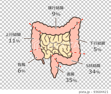 大腸がんの好発部位イラスト 大腸がんの好発部位イラスト 93684421