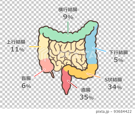 大腸癌多發部位圖解 93684422