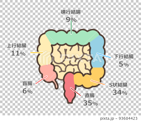 大腸癌多發部位圖解 93684423