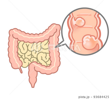 大腸ポリープの説明イラスト 93684425