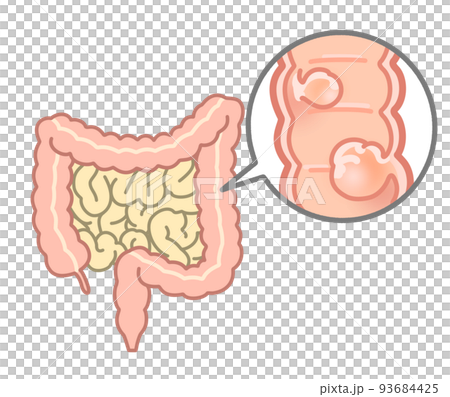 大腸ポリープの説明イラスト 93684425