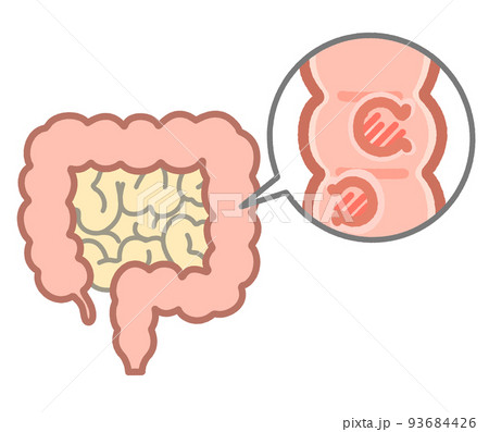 大腸ポリープの説明イラスト 大腸ポリープの説明イラスト 93684426