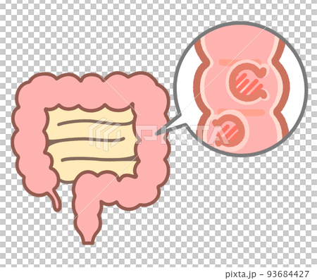 大腸ポリープの説明イラスト 93684427