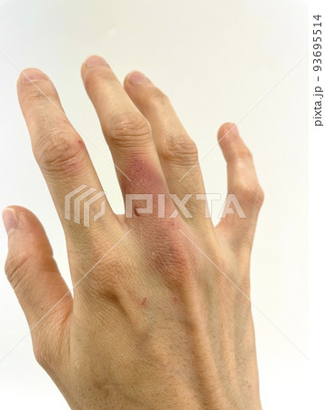 怪我して変色した右手 93695514