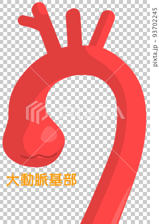 Aortic annulus dilatation 93702245