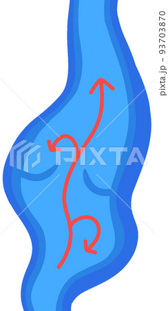 静脈瘤 静脈瘤 93703870