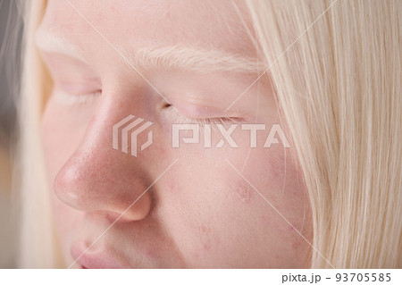 Close-up of young albino girl with natural appearance with white eyebrows and eyelashes 93705585