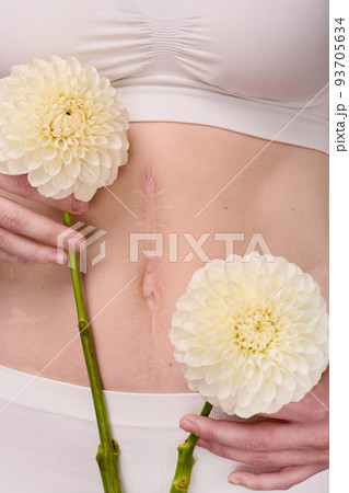 Close-up of young woman with scar on her body holding beautiful flowers in front of her 93705634