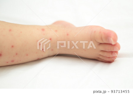 手足口病にかかった赤ちゃんの足 93713455