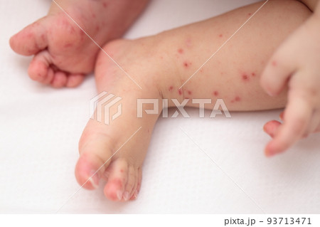 手足口病にかかった赤ちゃんの足 手足口病にかかった赤ちゃんの足 93713471