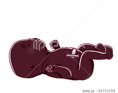 へその緒を切った後の新生児のイラスト へその緒を切った後の新生児のイラスト 93721259