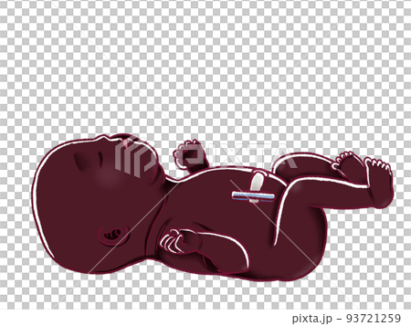 へその緒を切った後の新生児のイラスト へその緒を切った後の新生児のイラスト 93721259