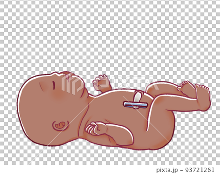 へその緒を切った後の新生児のイラスト へその緒を切った後の新生児のイラスト 93721261